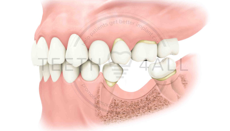 Why are dental implants so expensive?
