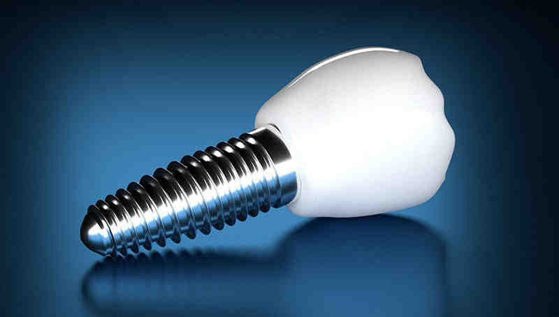 Why are dental implants so expensive in the US?