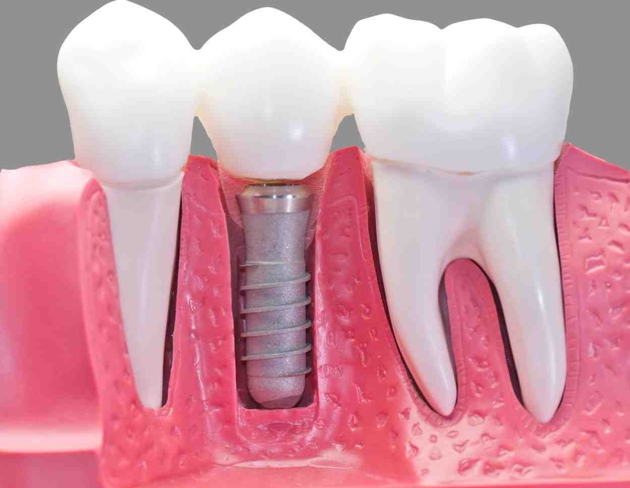 Why are dental implants so popular?