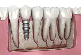 Why can't I get dental implants?