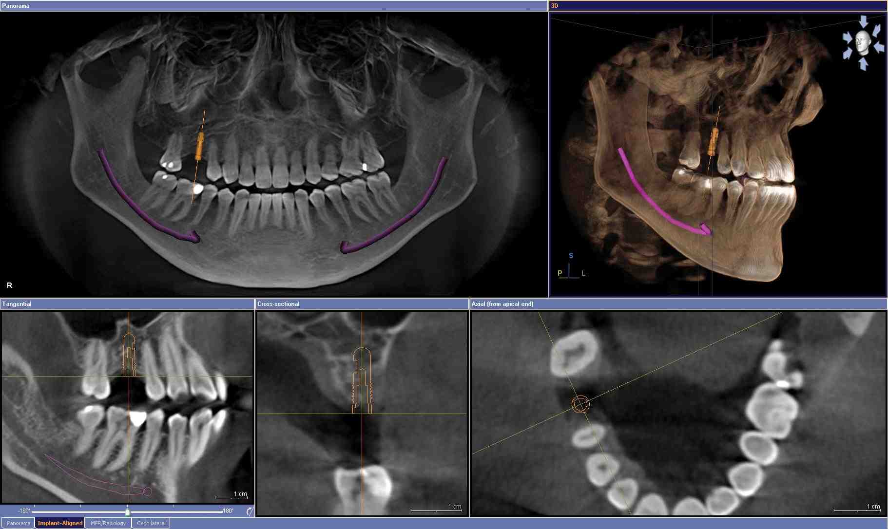 Why do I need a CT scan for dental implants?