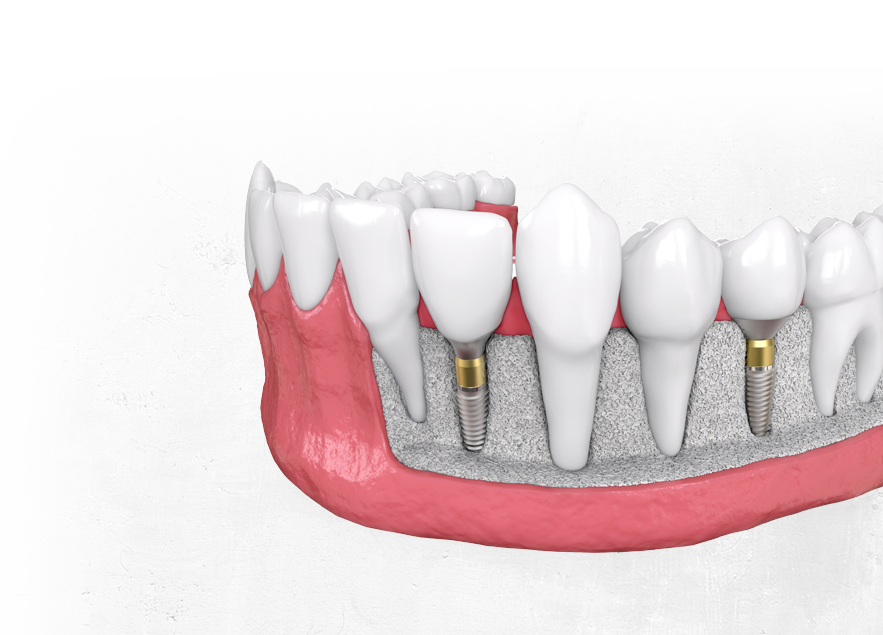 Why does my dental implant still hurt?