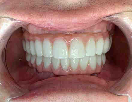 Will insurance cover all on 4 dental implants?