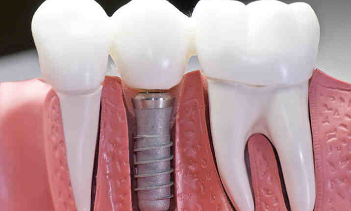 Are all titanium dental implant the same quality