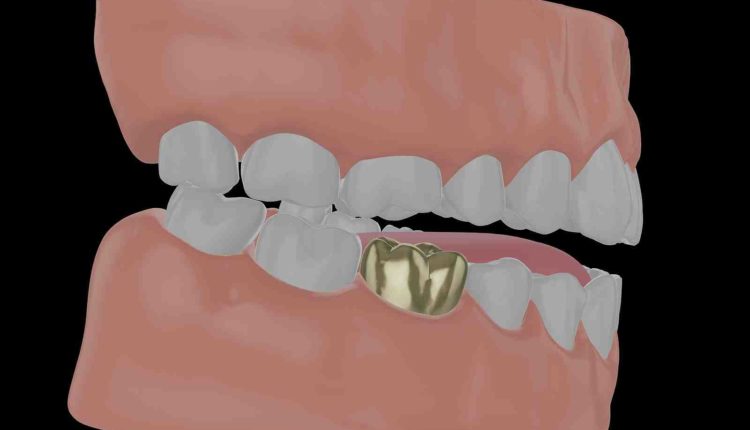 Are dental implant teeth as sharp as real teeth