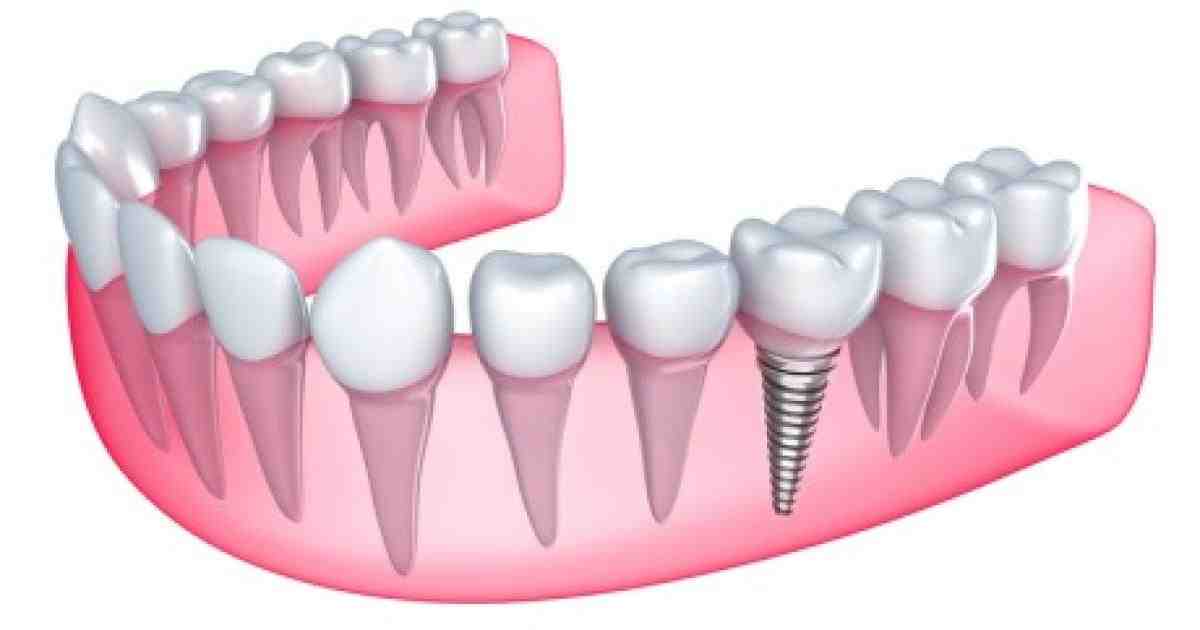 Are dental implants as strong as real teeth?