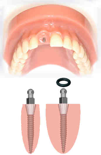 Are dental implants removable?