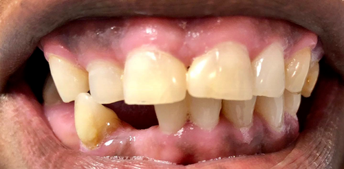 Are mini dental implants cheaper?
