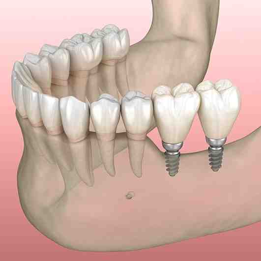 Are mini dental implants dentures?