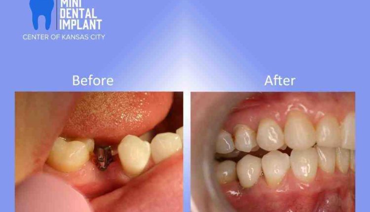 Are mini dental implants good