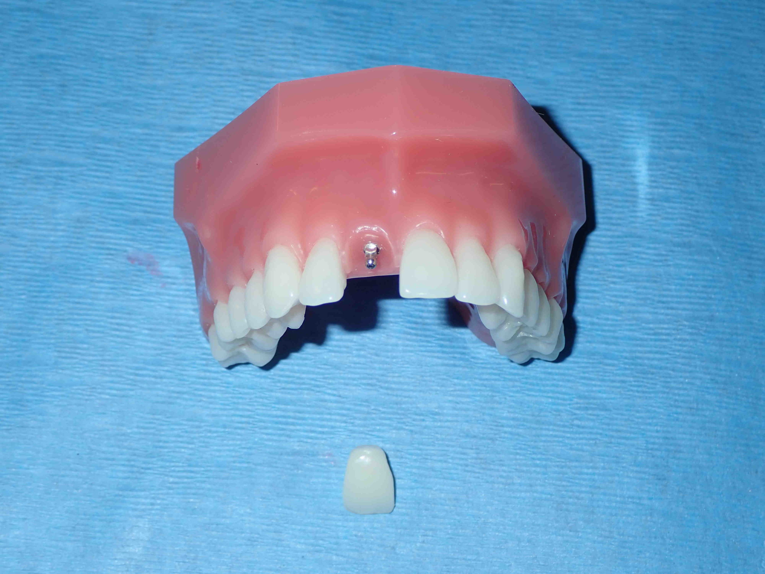 Are mini implants worth it?