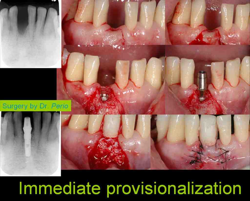 Can Dental Implants Make You Sick?