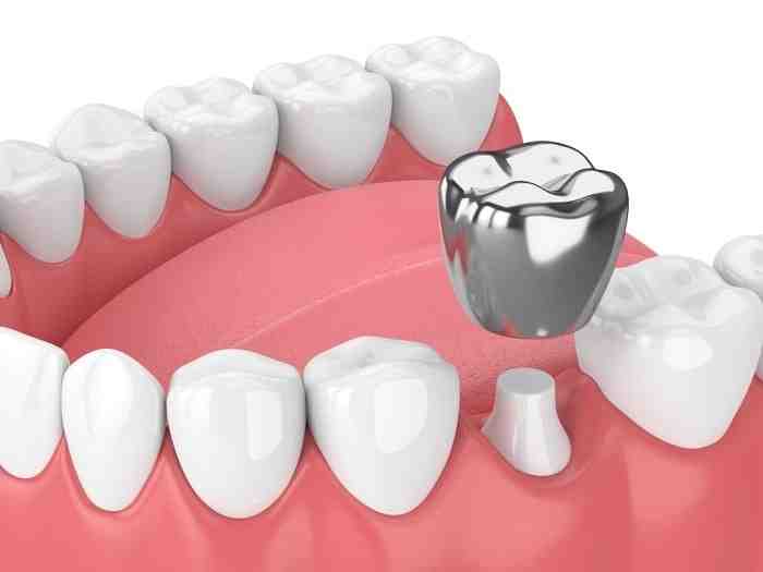 Do dental implants affect mri Dental News Network