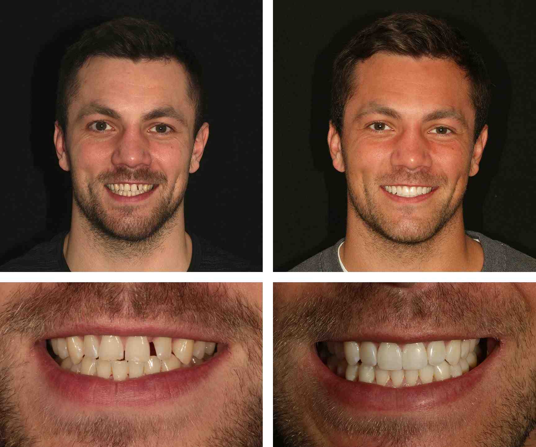 Cosmetic dentistry invisalign veneers Dental News Network