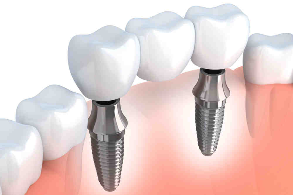 How to remove a dental implant Dental News Network