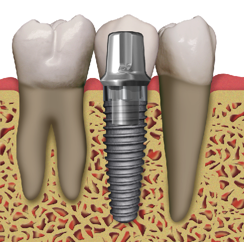Can a failed dental implant be replaced?
