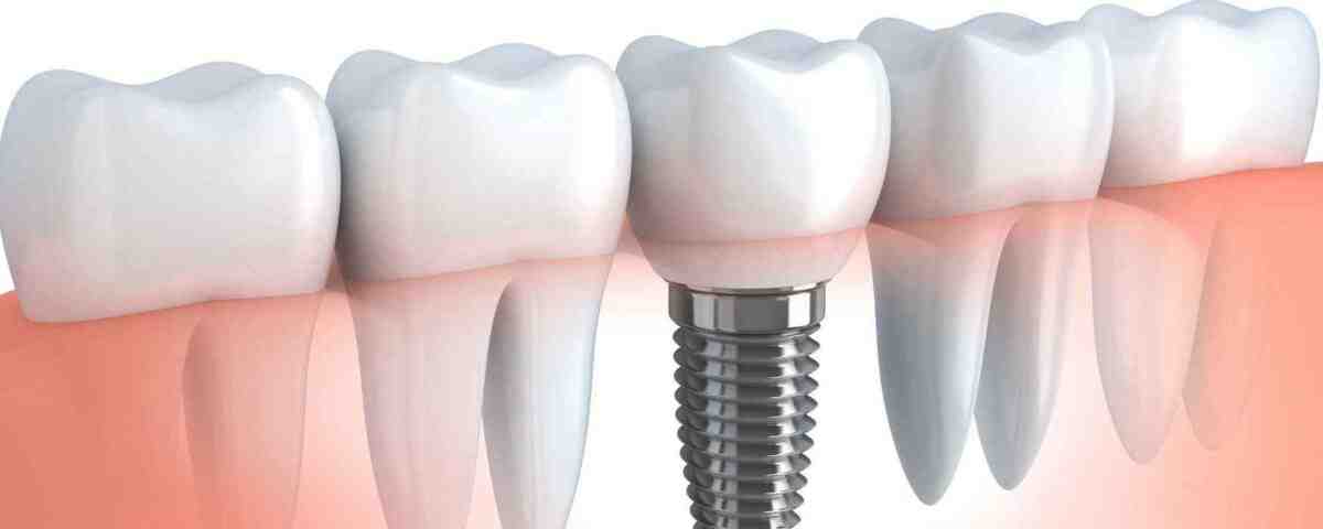 Can dental implants be covered by medical insurance?