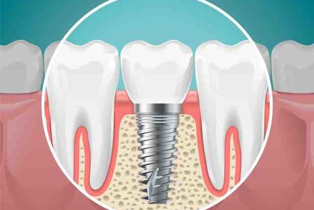 Can dental implants fall out