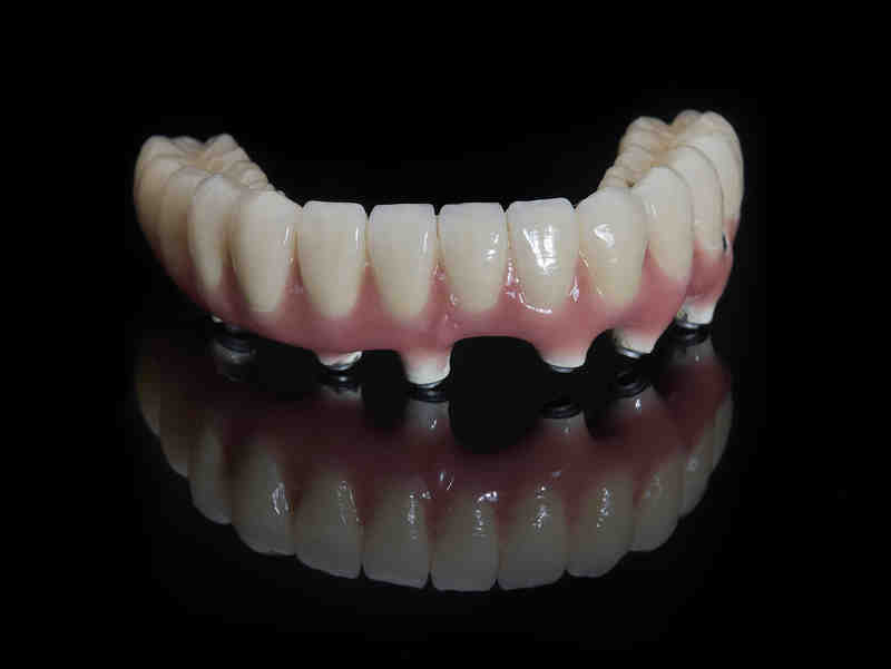 Can dentures be permanently attached?