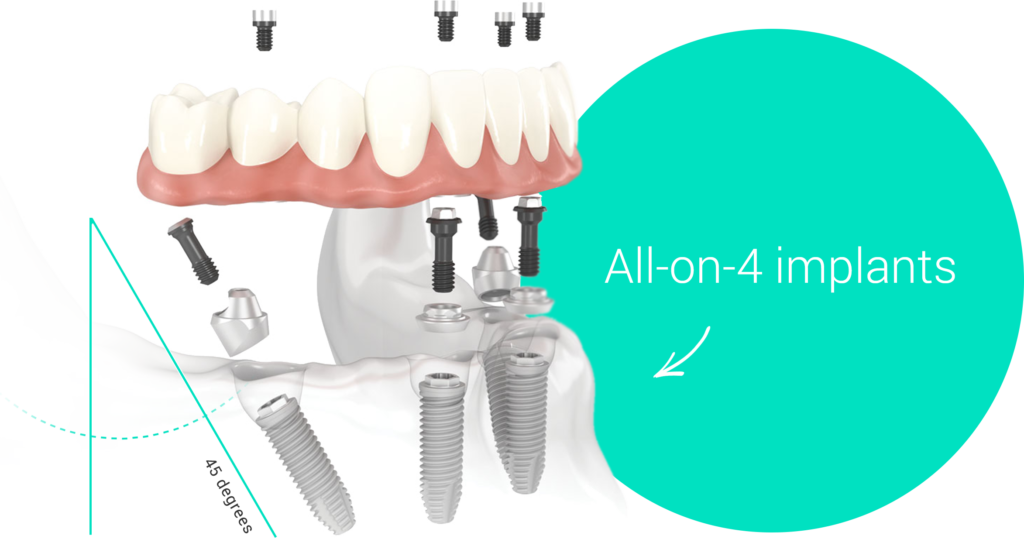 How do they do dental implants in one day Dental News Network