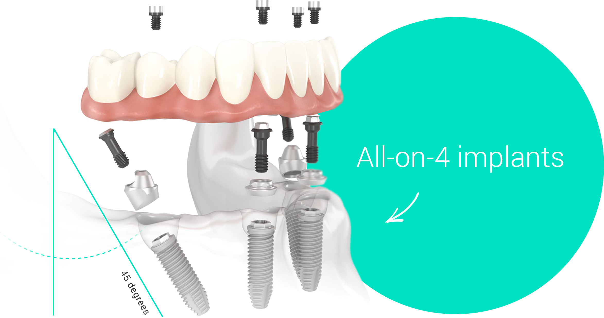Имплантация sup aznona com. Имплантация зубов по технологии «all on 4». Имплант Нобель all on 4. Аллон 4 протезирование.