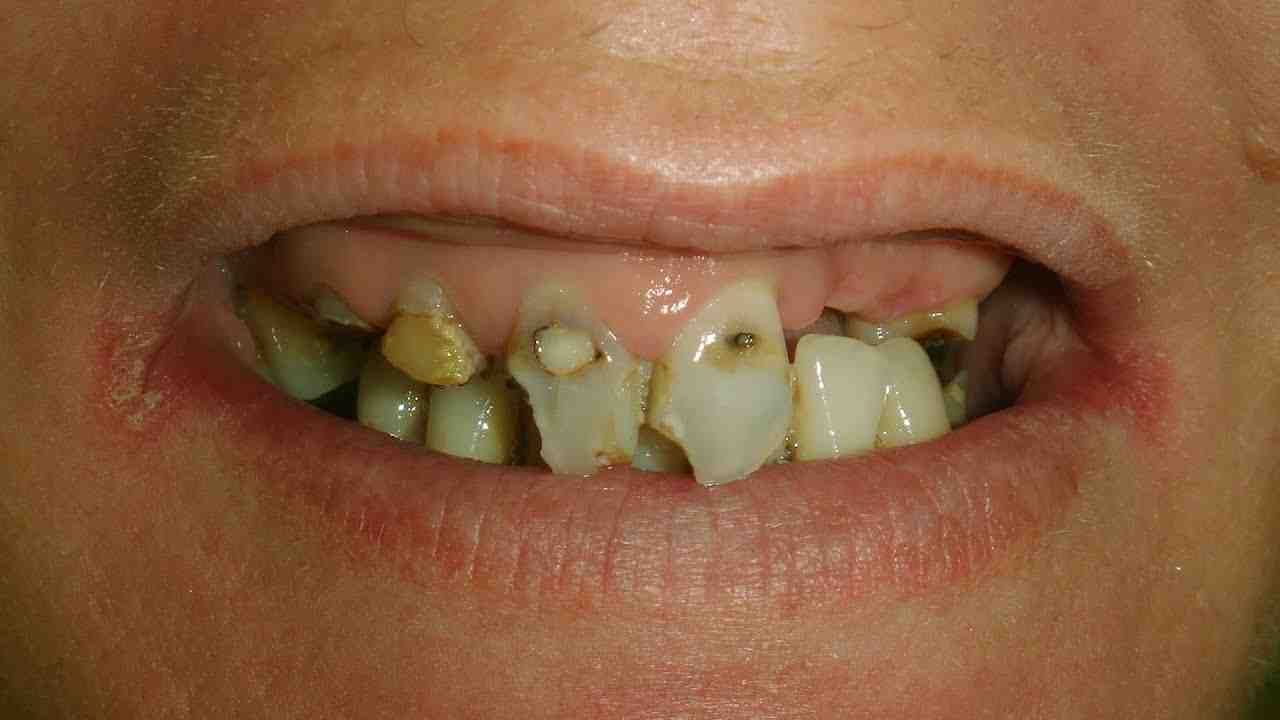 Can the mini dental implant be removed Dental News Network