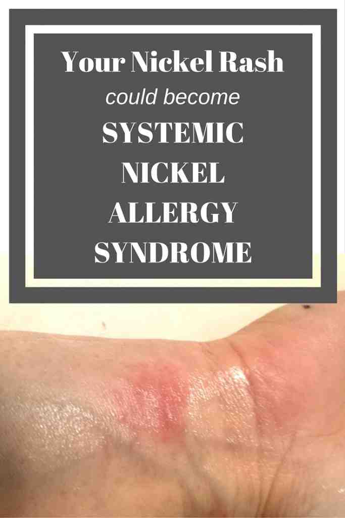 Can dental implants cause hives Dental News Network