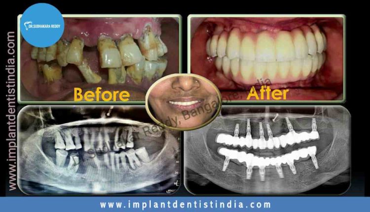 Can you have dental implants with bone loss