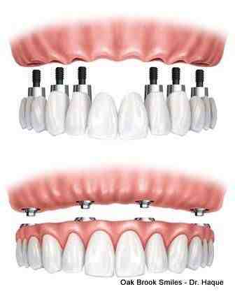 Can you remove an implant?