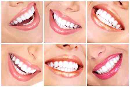 Can you whiten teeth with an implant?