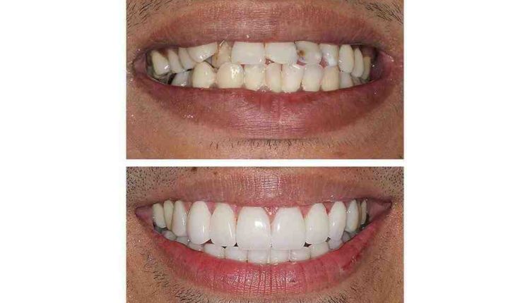 Cosmetic dentistry invisalign veneers