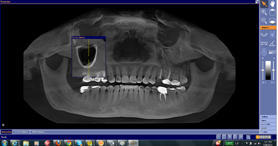 Do dental crowns affect MRI?