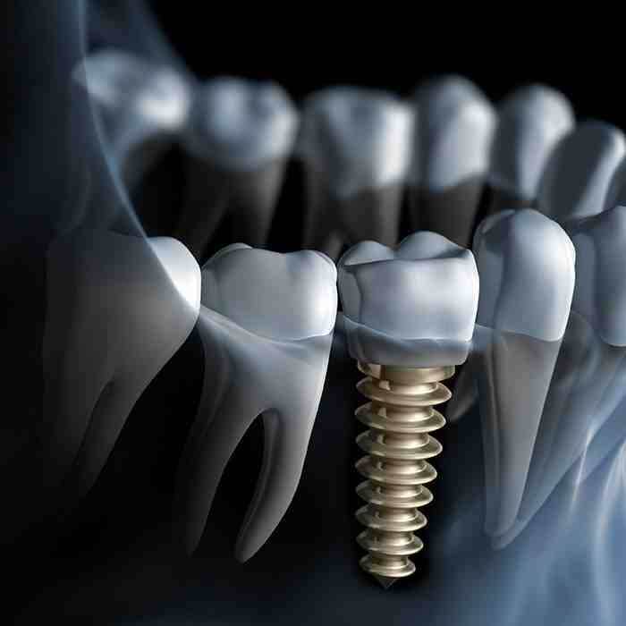 What insurance pays for dental implants Dental News Network
