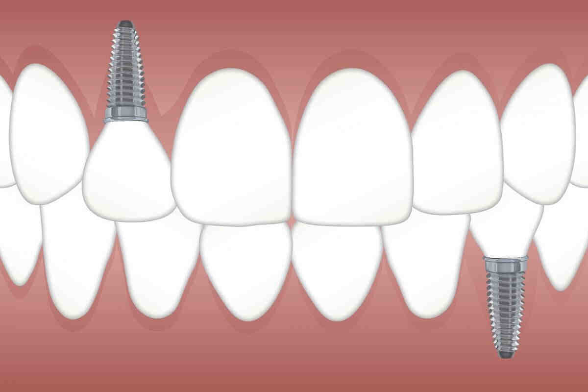 Do most dentists do implants?
