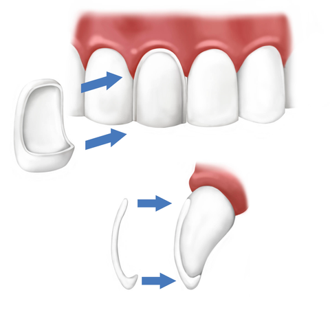 Does Ma cover dental implants?