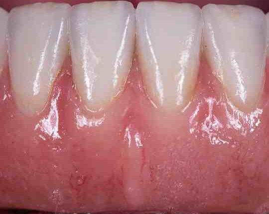 Does signature dental care in murrieta do all on 4 implant procedure