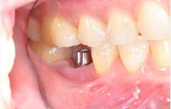 Does the army do dental implants