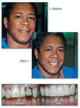 How Much Does a full dental makeover cost?