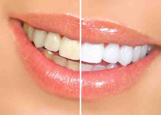 How Much Does a full dental makeover cost?