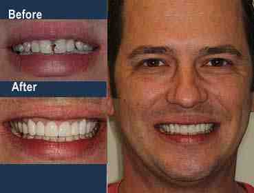 How Much Does a full dental makeover cost?