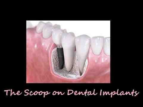 How can I ease the pain of dental implants?