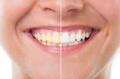 How can I whiten my dental implants?