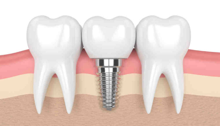 How do dental implants cost