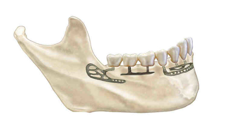 How do i know if my dental implant is healing correctly