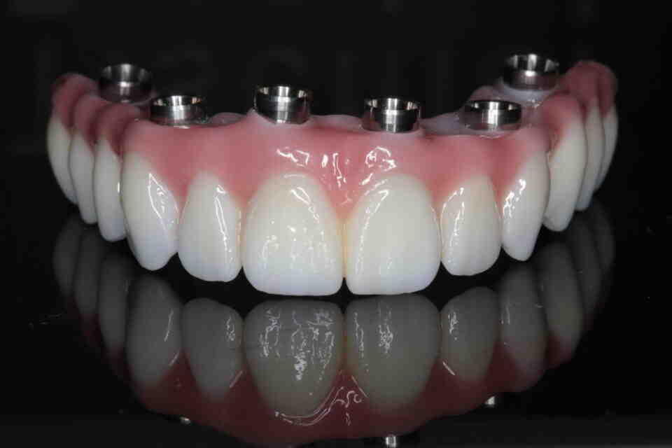 How do they do full dental implants in one day?