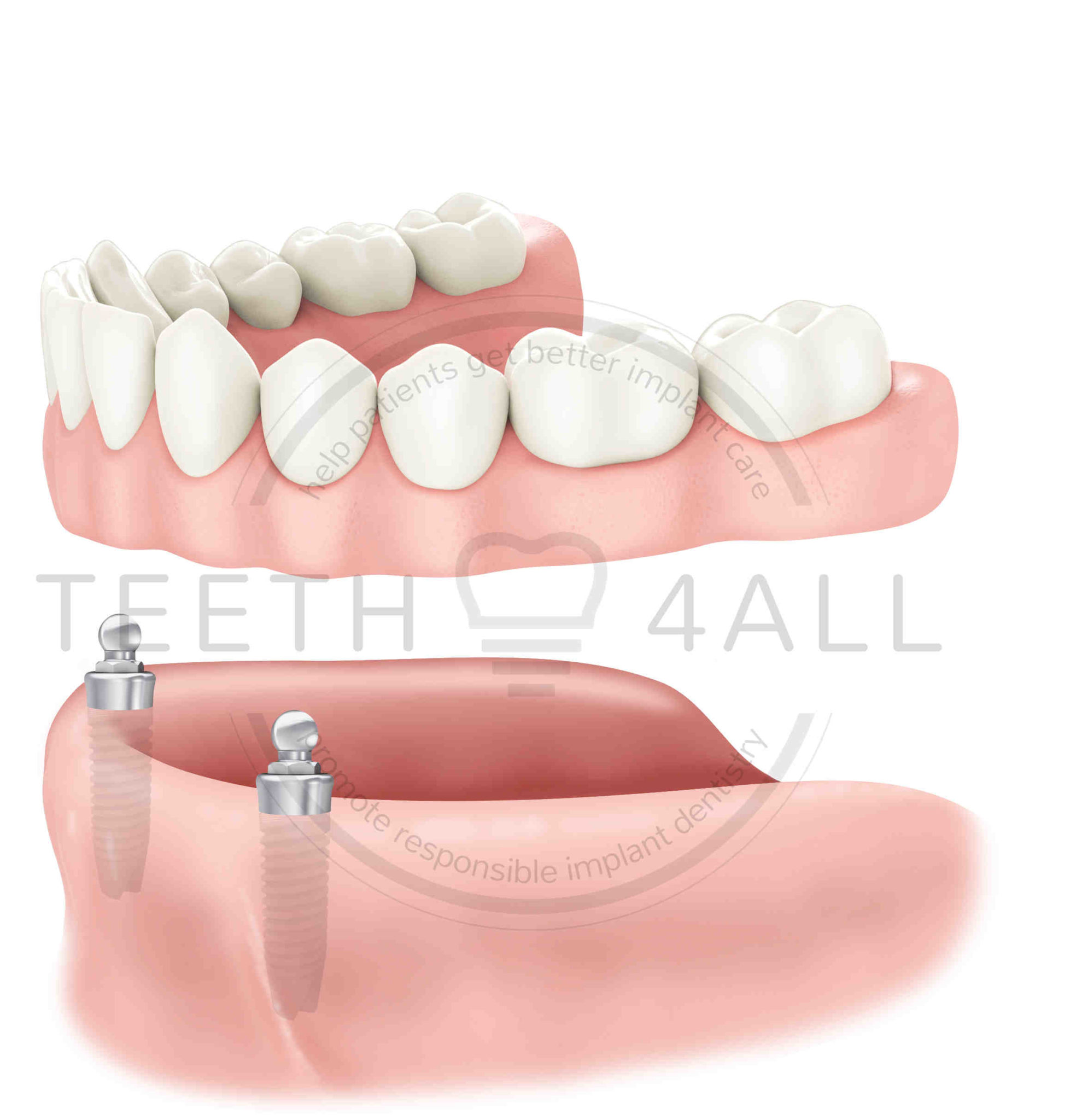 How to clean fixed dental implants Dental News Network