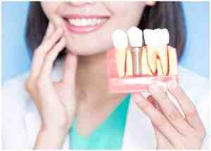 How do you get stains off dental implants?