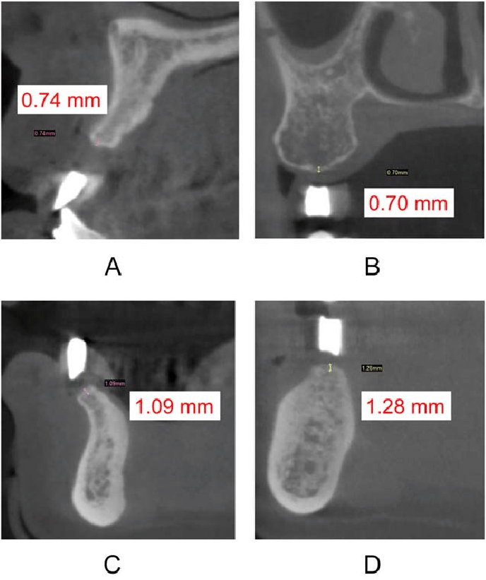 how-to-read-cbct-for-dental-implants-dental-news-network