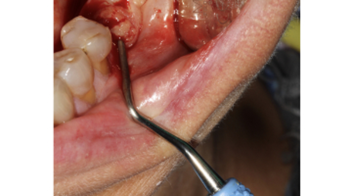 How do you know if a dental implant is failing?