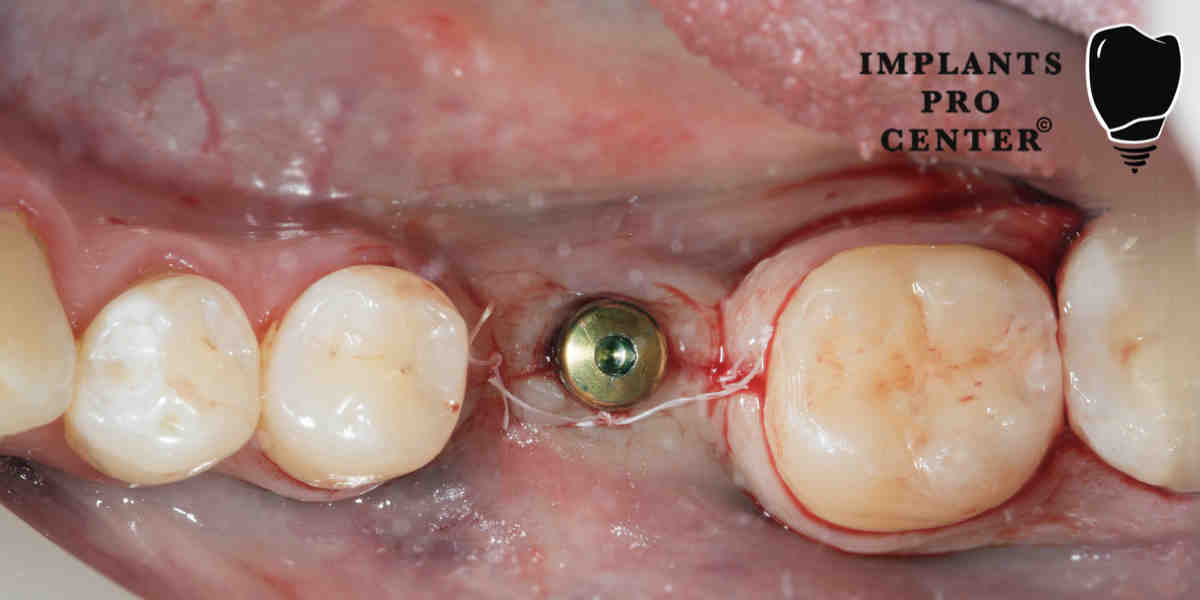 How is a dental implant done?